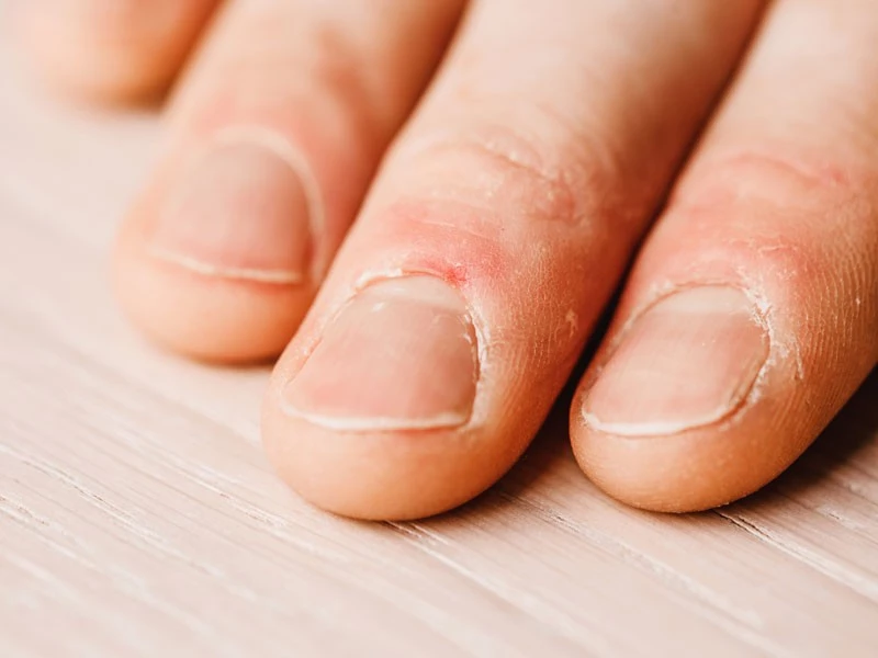 Schrunden Am Finger Behandeln Und Vermeiden Compeed